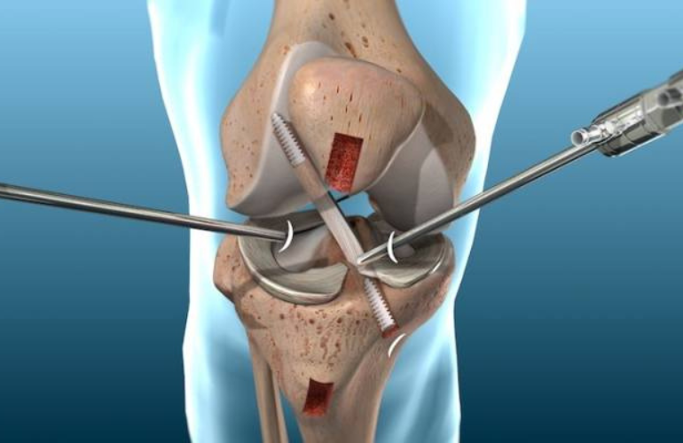 Arthroscopy