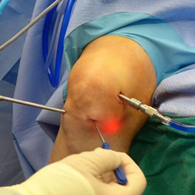 Arthroscopy Procedure