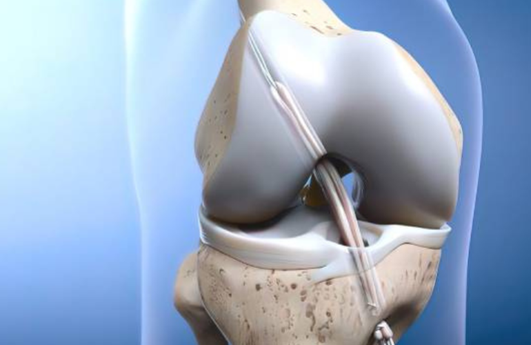 ACL Reconstruction
