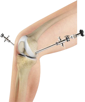 Arthroscopy