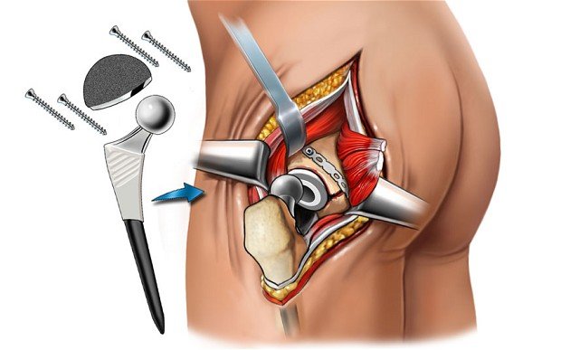 Hip Surgery Procedure