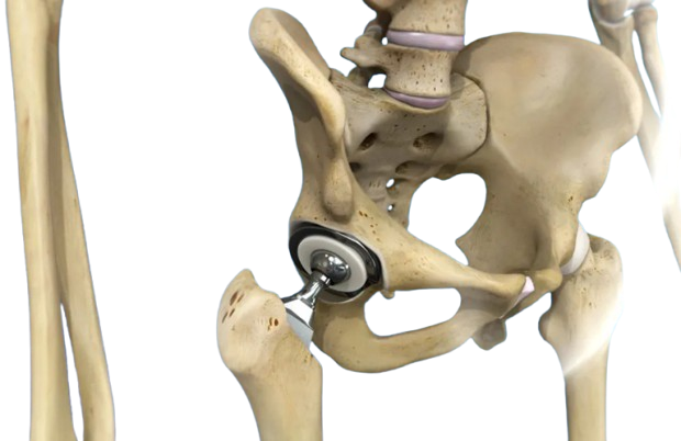 Hip Surgery