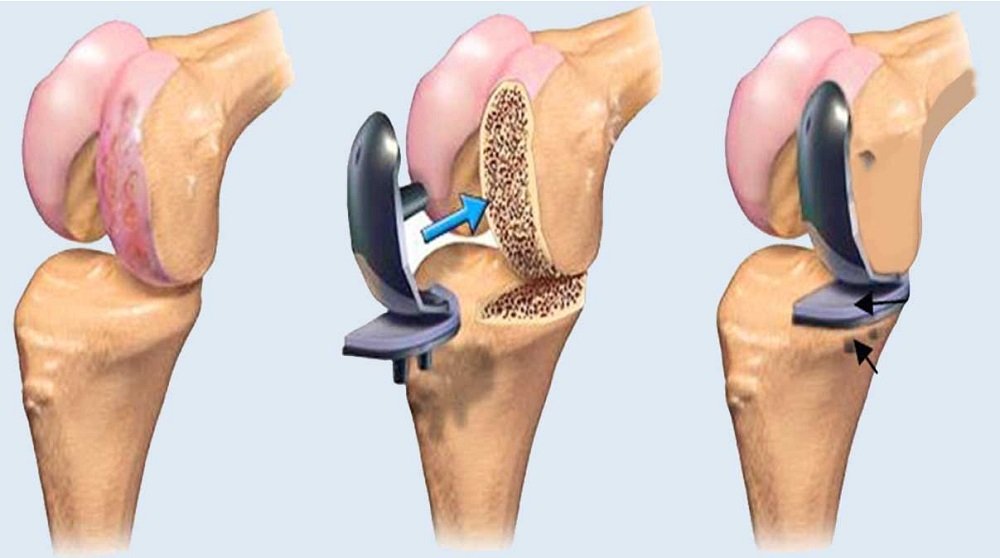 Knee Surgery